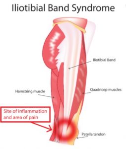 illiotibial band syndrome, knee pain in runners, runners knee, illiotibial tract, illiotibial, physio adelaide, adelaide physio, physio near me, physio appt today, physio open now