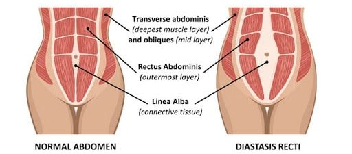 Abdominal separation, Diastasis recti, Physiotherapist, physio near me, pregnancy, pregnant