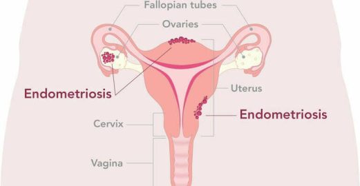 Endometriosis_2