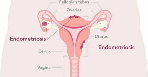 Minimally invasive treatment for endometriosis and pelvic health at Core Physio & Pilates.