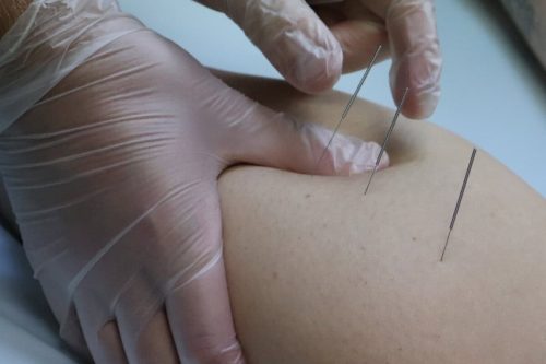 Local dry needling Adelaide